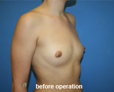 plastic-surgery-breast-augmentation